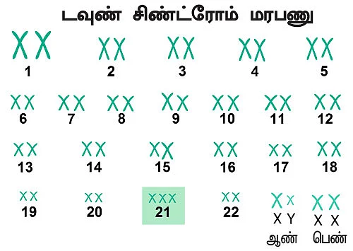 குழந்தைகளை பாதிக்கும் டவுண் சிண்ட்ரோம்