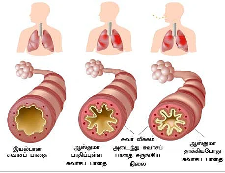 ஆஸ்துமா