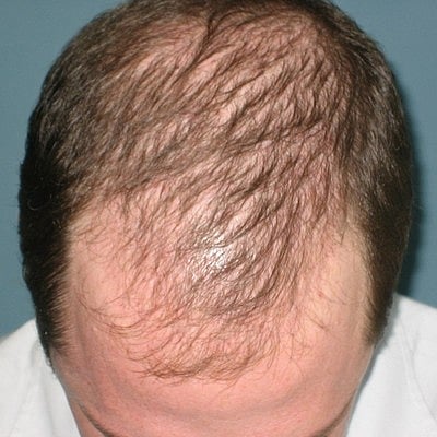 `வழுக்கைத் தலையால் சங்கடம்’- மாதம் ரூ 6,000 வழங்குமாறு அரசுக்கு நூதன கோரிக்கை