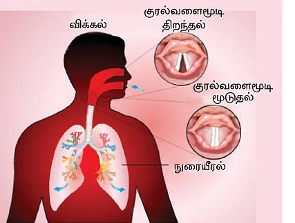 விக்கலா சிக்கலா?
