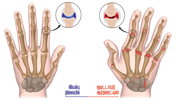 அலர்ஜியை அறிவோம் - 17