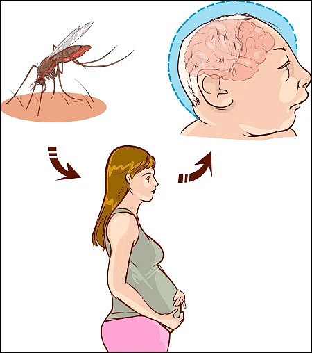 ஜிகா வைரஸ் - மிரள வேண்டாம்... மீளலாம்!