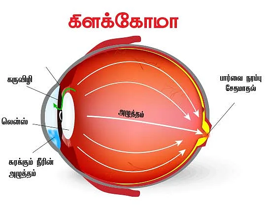 கிளக்கோமா பார்வையை பறிக்கும் கண் அழுத்தம்!