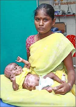 தானாக எரிந்த குழந்தை
