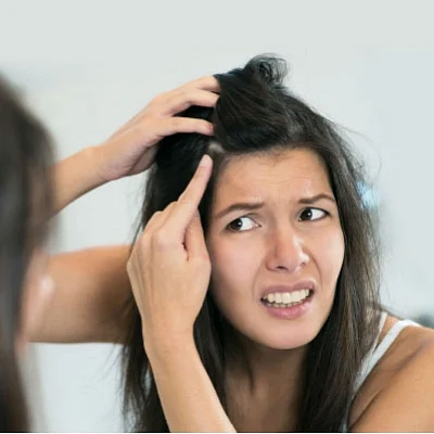 பொடுகுத் தொல்லை (Representational Image)
