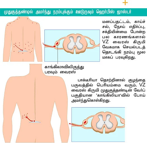 அக்கி வந்தால் அம்மை வருமா?