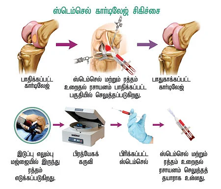 ஸ்டெம்செல் கார்டிலேஜ் சிகிச்சை