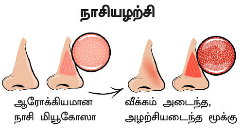 அலர்ஜியை அறிவோம் - 6