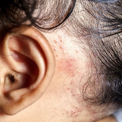 அலர்ஜியை அறிவோம் - 10