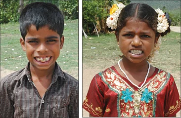 அச்சுறுத்தும் ஃப்ளுரோஸிஸ்!