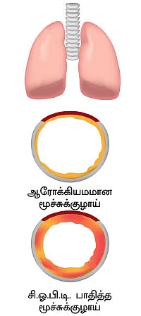 சி.ஓ.பி.டி அச்சம் வேண்டாம்!