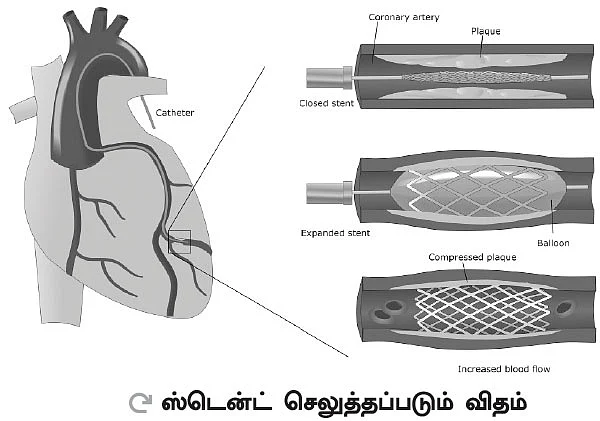இதய நலம் என்ன ஆகும்? - ஸ்டன்ட் அடிக்கும் ‘ஸ்டென்ட்’ பிரச்னை!