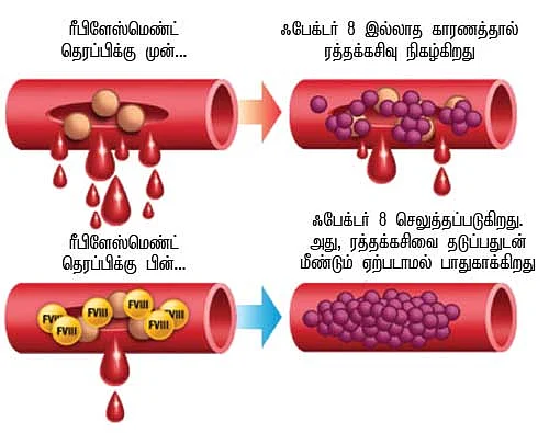 ஆண்களைப் பாதிக்கும் ஹீமோபிலியா