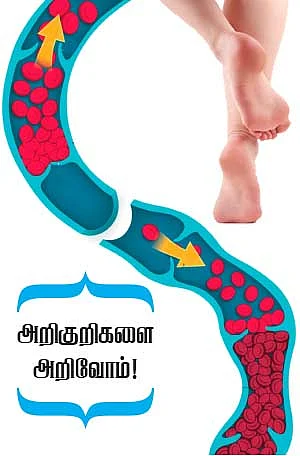 வெரிகோசிஸ் வெயின்