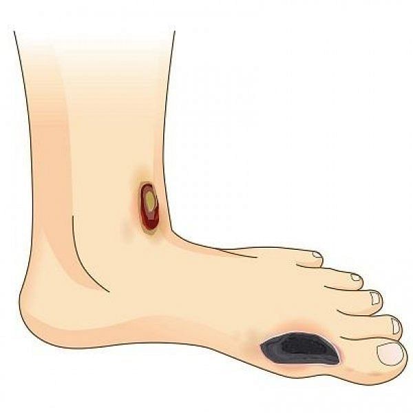 Preventive steps to protect the feet – Do’s and Don’ts for the diabetic patients