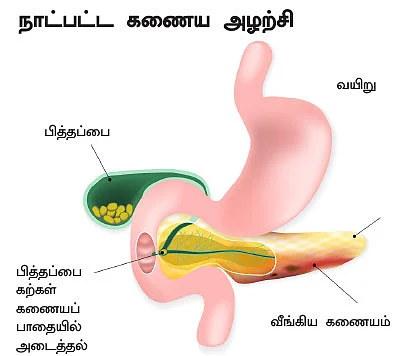 கணையம் காப்போம்!