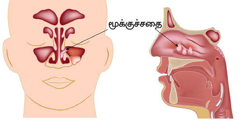 அலர்ஜியை அறிவோம் - 6