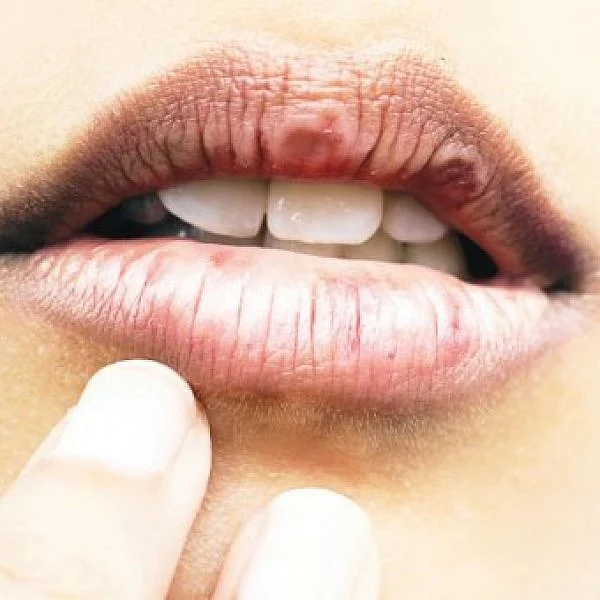 குளிர்காலத்தில் வறண்ட உதடுகளுக்கு குட் பை சொல்லலாமே! #BeautyTips