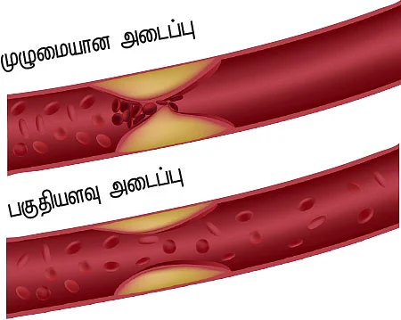 இதய நோய்கள் ஆண் VS பெண்