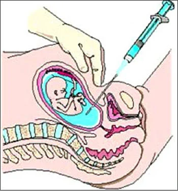 குழந்தைகளை பாதிக்கும் டவுண் சிண்ட்ரோம்