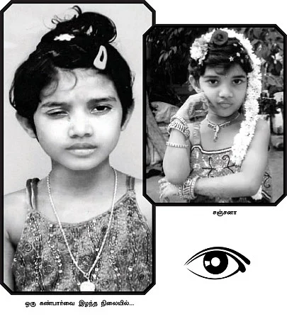 கண் இழந்த மாணவி... கண்டுகொள்ளாத பள்ளி!