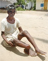 அச்சுறுத்தும் ஃப்ளுரோஸிஸ்!