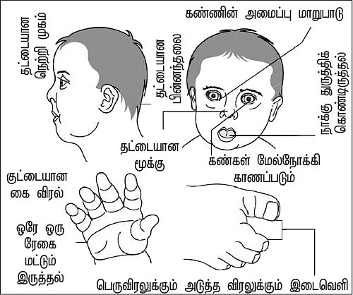 குழந்தைகளை பாதிக்கும் டவுண் சிண்ட்ரோம்
