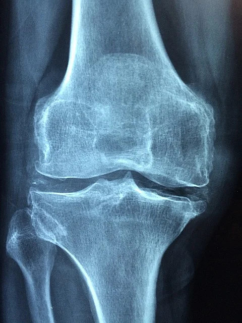 knee pain