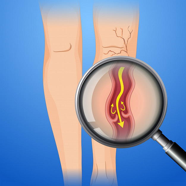 Varicose veins