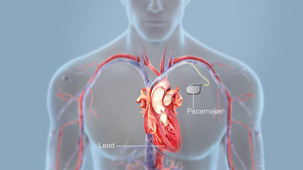 Установка сердца. Водитель ритма сердца пейсмейкер. Имплантация сердца кардиостимулятор. Трехкамерный дефибриллятор для сердца. Электрокардиостимулятор на человеке.