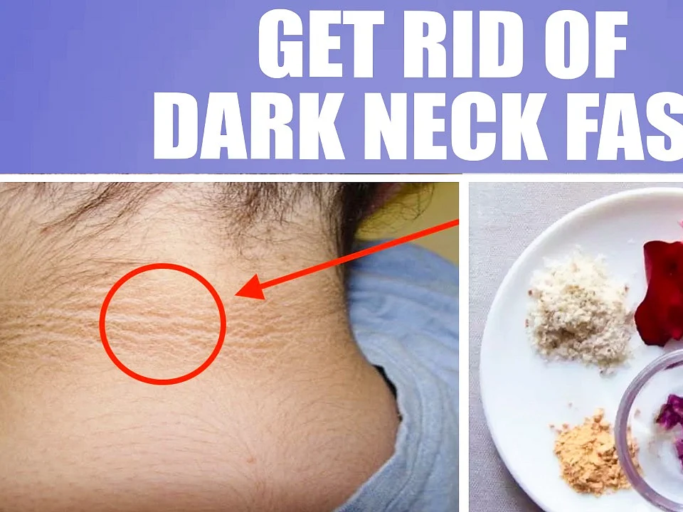 How to: கழுத்துக் கருமையில் இருந்து விடுபடுவது எப்படி? | How to get rid of dark neck?