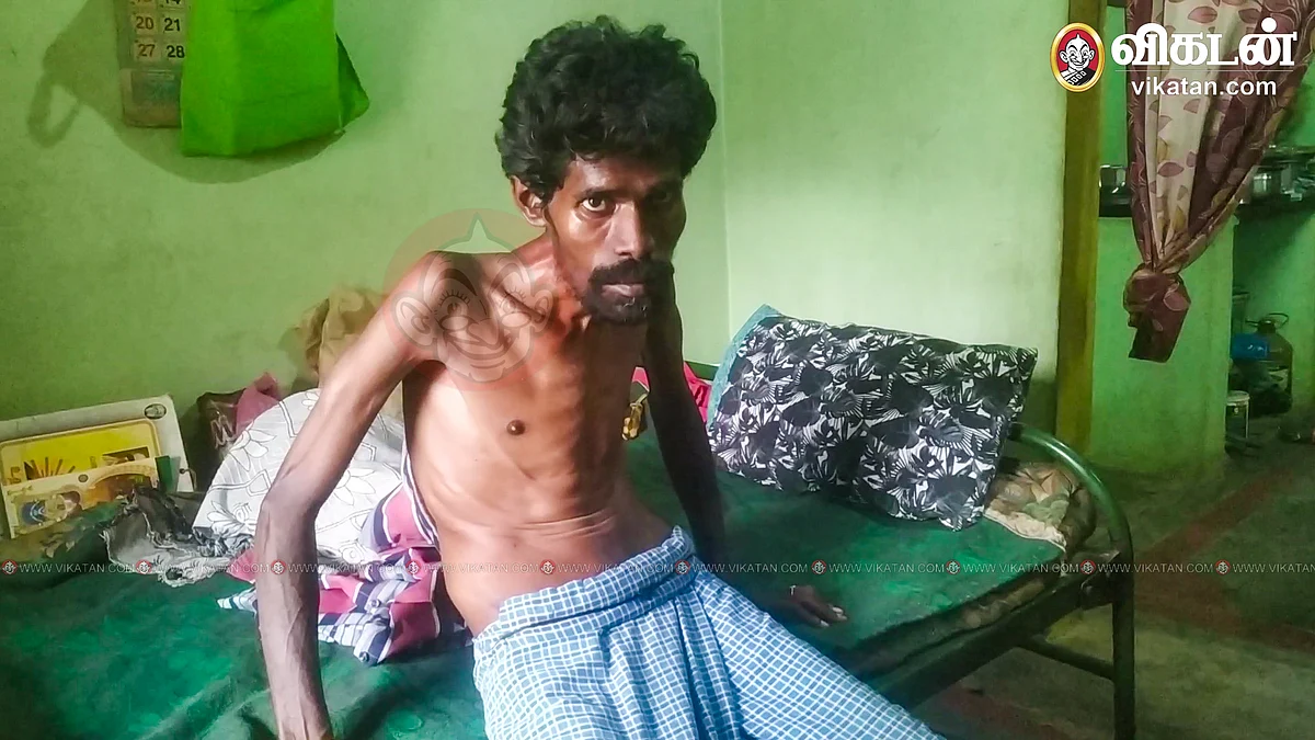 விநோத நோயால் பாதிக்கப்பட்ட தமிழரசன்