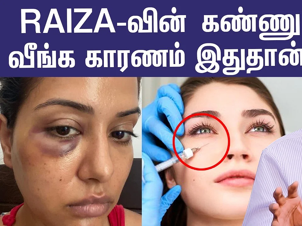 Facial treatments ஆபத்தா? 😲 Raiza-க்கு என்ன ஆச்சு? | Doctor Explains About Cosmetic Procedures