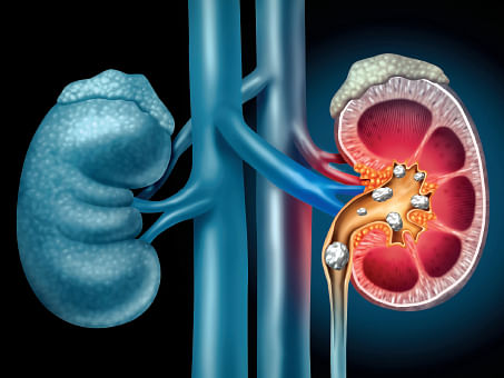 How to: சிறுநீரகக் கல் ஏற்படாமல் தடுப்பது எப்படி? | How To Prevent Kidney Stones?