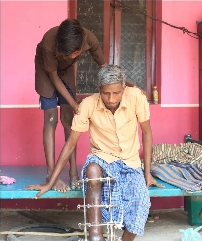 காலில் கம்பி கட்டப்பட்ட நிலையில் சோமசுந்தரம்