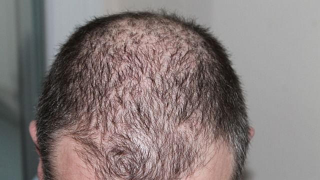 Hair loss (Representational Image)