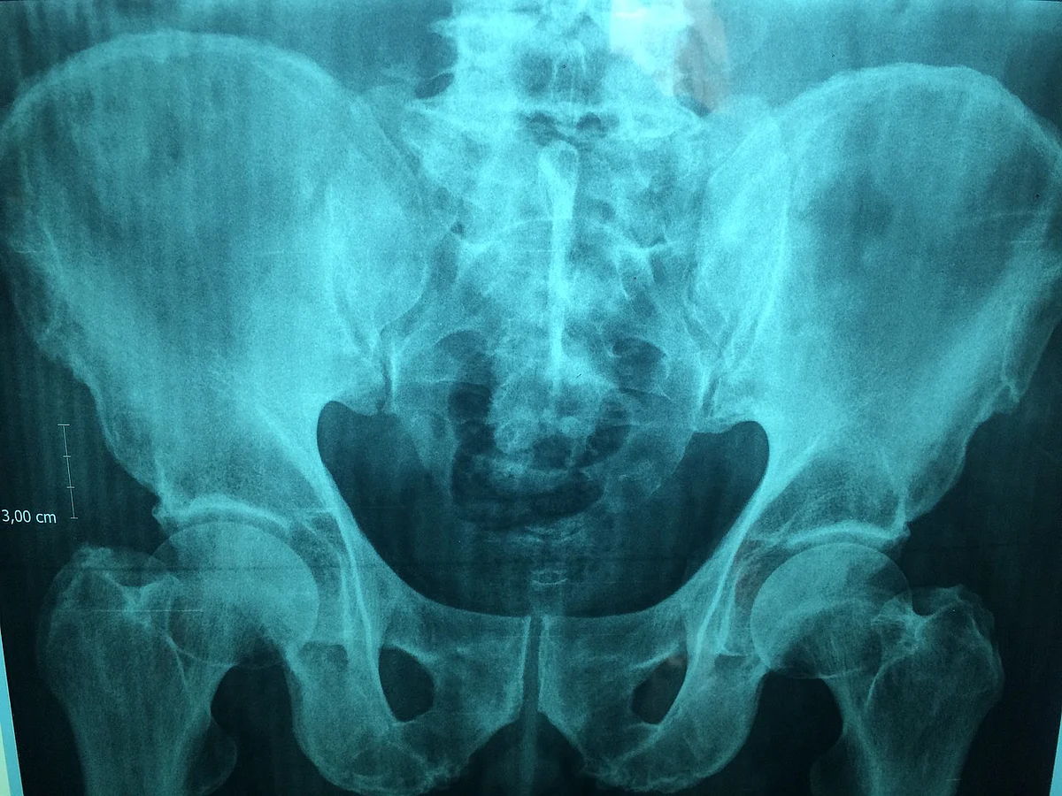 கரும்பூஞ்சையைத் தொடர்ந்து Bone Death; கோவிட்டிலிருந்து குணமானவர்களைக் குறிவைக்கும் புதிய பிரச்னை!