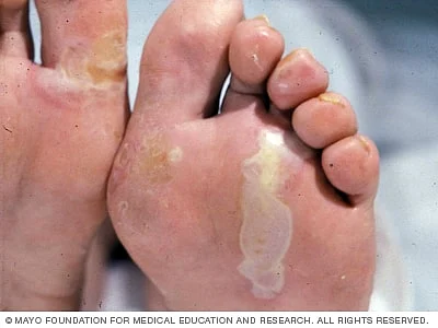 Epidermolysis Bullosa