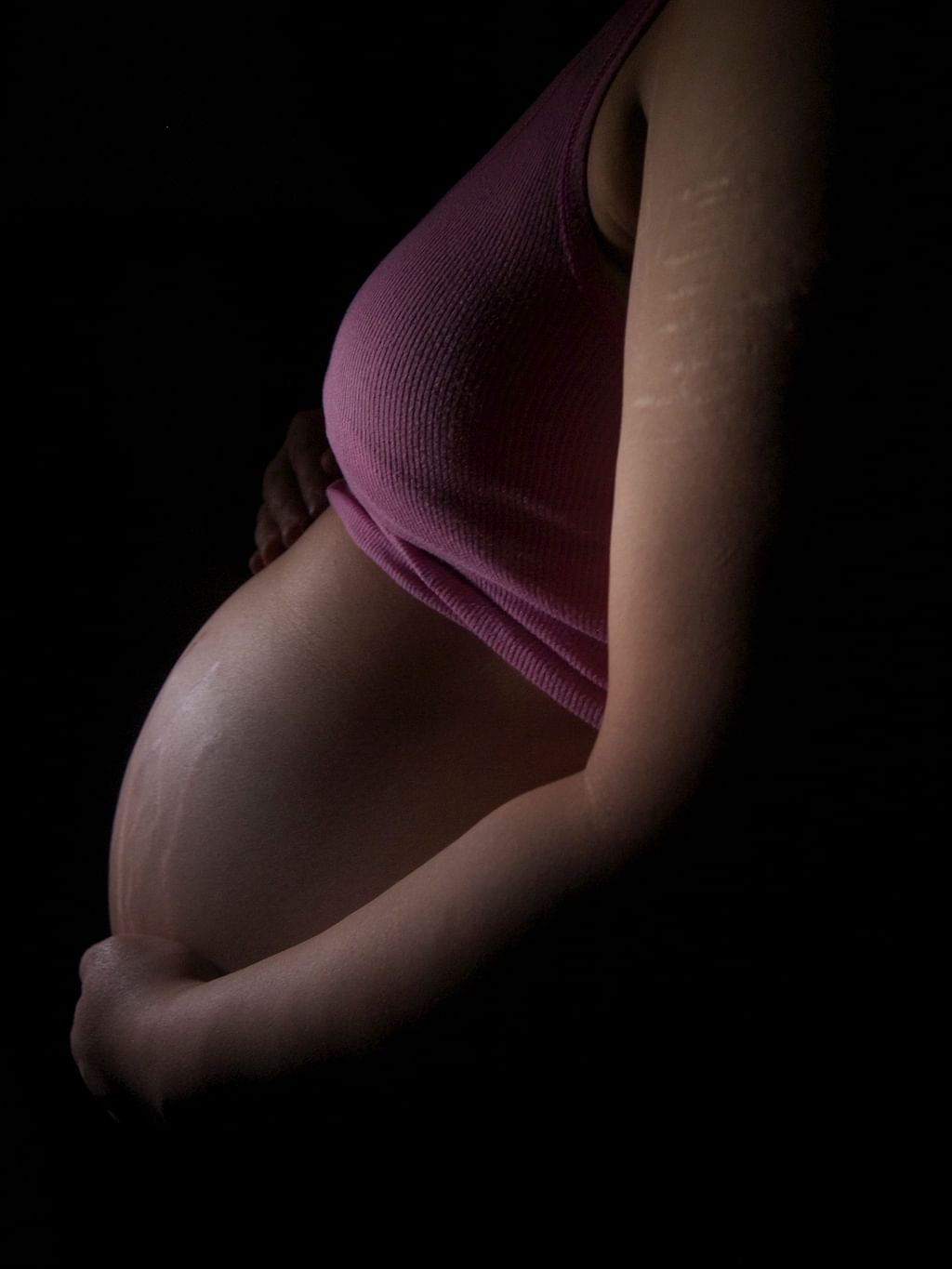 Stretch marks(Representational Image)