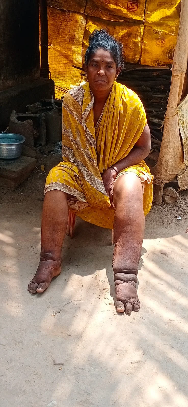 கால்கள் பாதிக்கப்பட்ட பெண்
