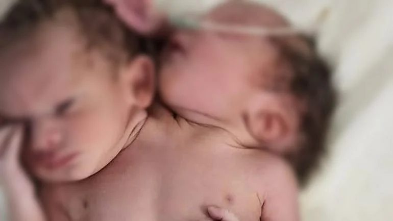 Conjoined Twins