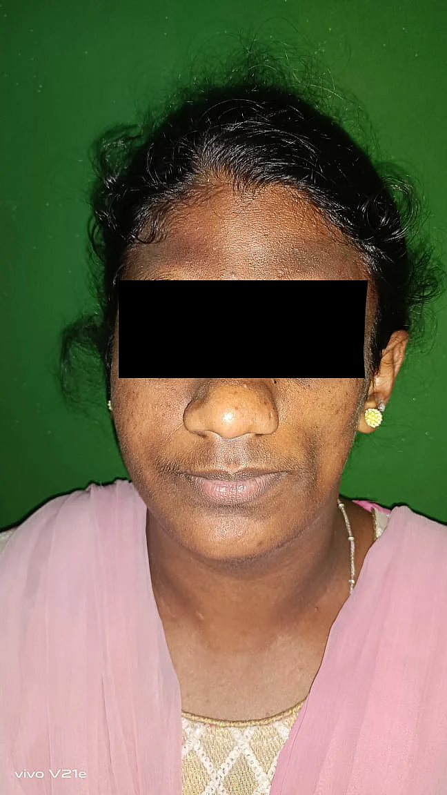 அரிதான நோயால் பாதிக்கப்பட்ட பெண்
