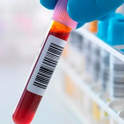 Blood Test (Representational Image)