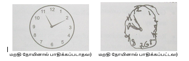 கடிகாரம் வரையும் பரிசோதனை