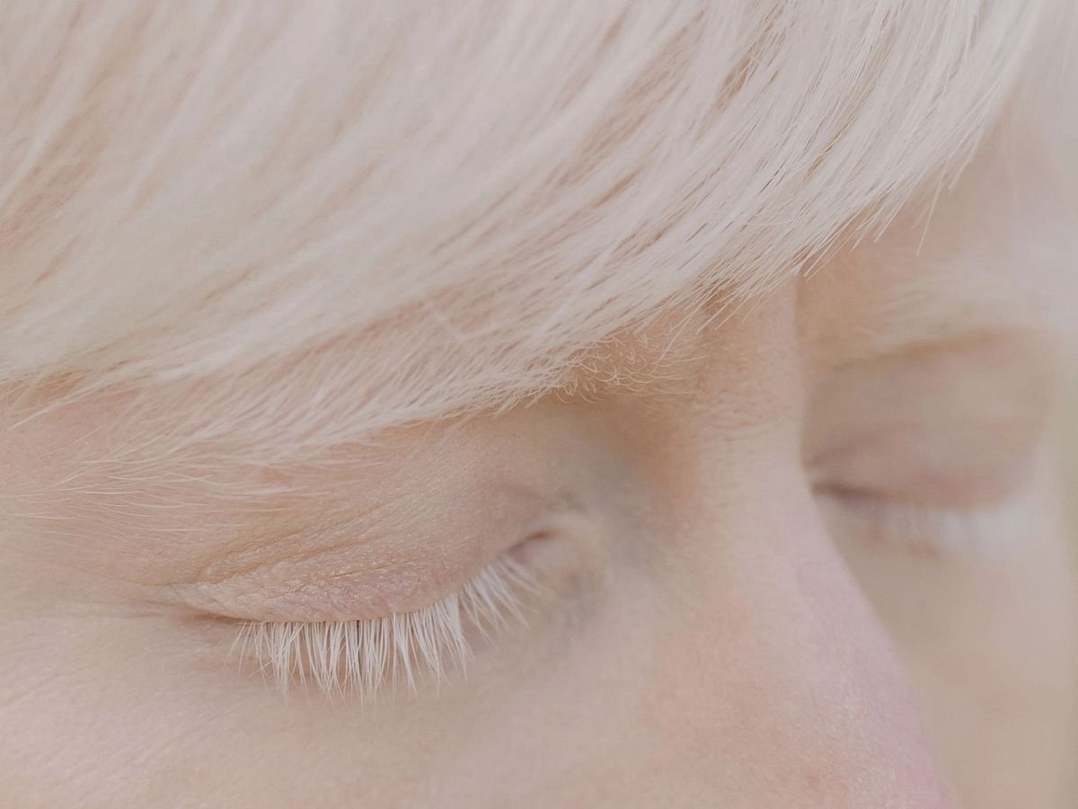 சர்வதேச அல்பினிசம் விழிப்புணர்வு தினம்; வெண்தோல் குறைபாடு தொற்றுநோயல்ல! I Albinism I Visual Story
