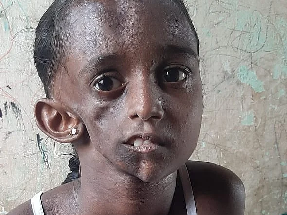 ``எட்டு வீடு மாறிட்டோம்; பொண்ணு தவிக்கிறா!" - முகச்சிதைவு நோய் பாதித்த சிறுமியின் தந்தை உருக்கம்