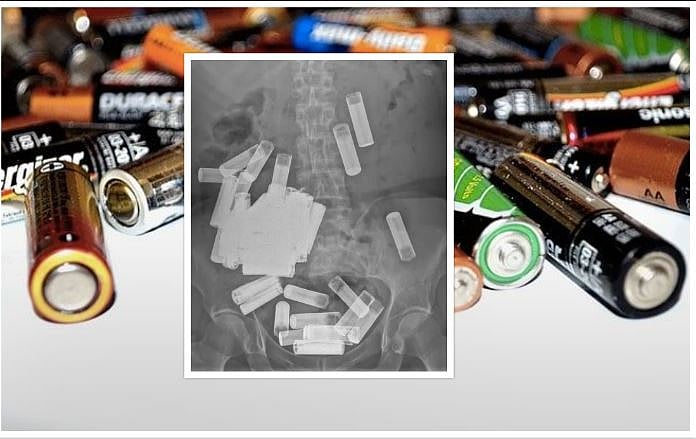 65 வயது பெண்ணின் வயிற்றில் 55 பேட்டரிகள்... மன அழுத்தத்தால் பெண் எடுத்த விபரீத முடிவு!