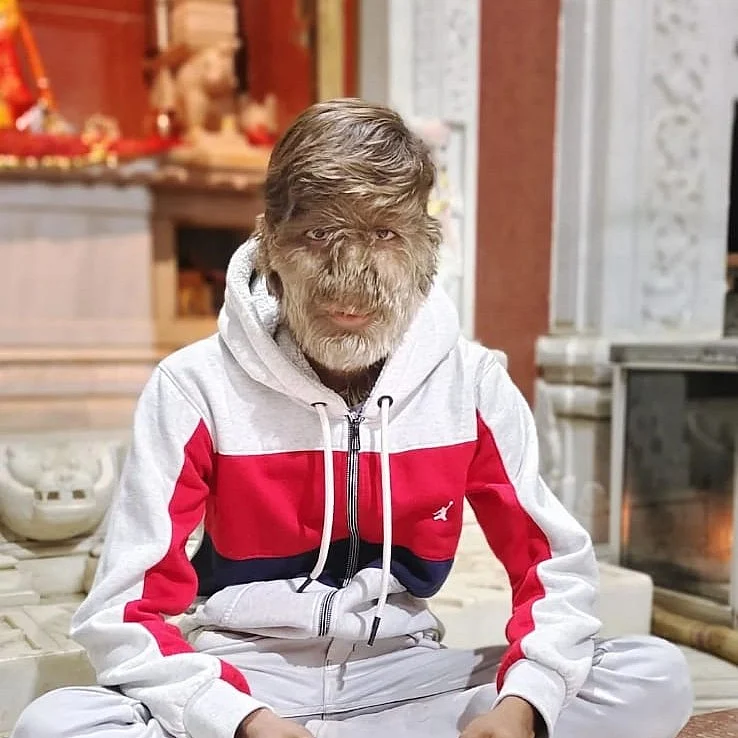 `நான் கடித்துவிடுவேன் எனக் குழந்தைகள் பயப்படுகிறார்கள்' அசாதாரண முடி வளர்ச்சிக்குள்ளானவரின் சோகம்!