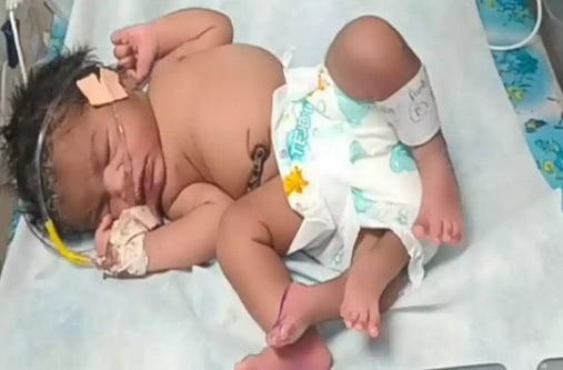 நான்கு கால்களோடு பிறந்த பெண் குழந்தை; மருத்துவர்கள் சொல்லும் காரணம் என்ன? 