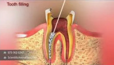 வேர் சிகிச்சை முறை